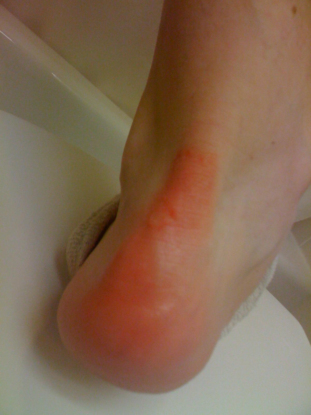 Blister